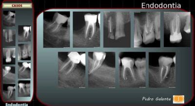 patenesia|patencia endodontia.